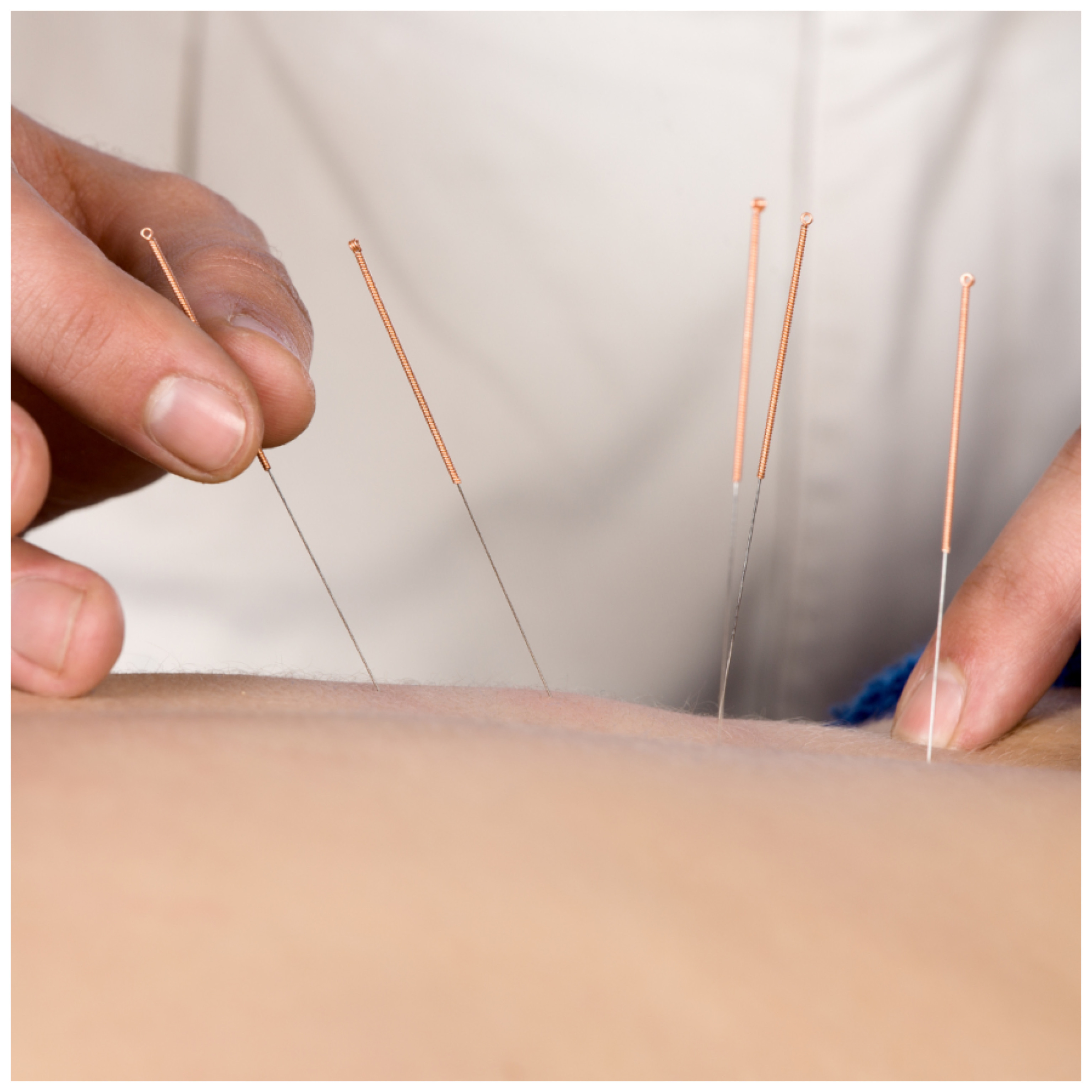 Akupuntur acupunture